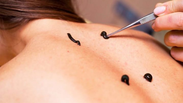 Курс гирудотерапии в Астане