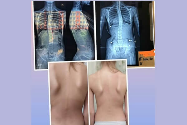 Курс остеопластики в Астане